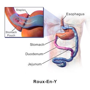 Roux-en-Y gastric bypass gastrik baypas